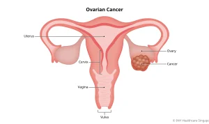 Kanker Ovarium: Penyebab dan Gejalanya