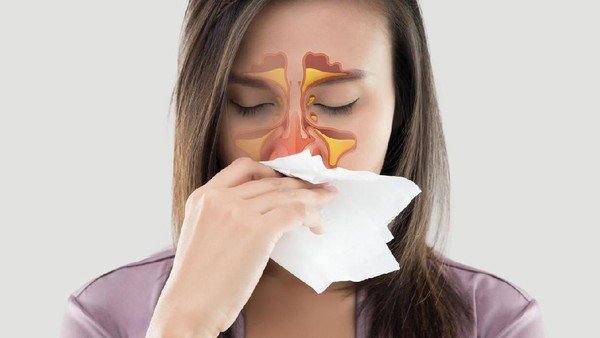 Gejala Sinusitis